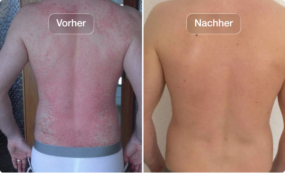 Vorher-Nachher-Foto eines Rückens: deutliche Verbesserung des Hautbilds nach einer natürlichen Kur oder Pflegeanwendung.