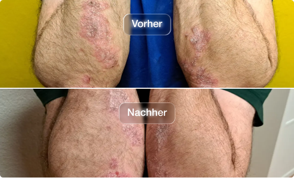 Vorher-Nachher-Fotos von Ellenbogen mit sichtbarer Hautverbesserung – beruhigte, regenerierte Haut nach einer natürlichen Kur.